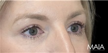 Eyelid Surgery After Photo by Munique Maia, MD; Tysons Corner, VA - Case 51309