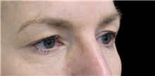 Eyelid Surgery Before Photo by Munique Maia, MD; Tysons Corner, VA - Case 51309