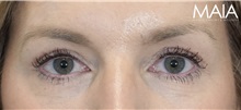 Eyelid Surgery After Photo by Munique Maia, MD; Tysons Corner, VA - Case 51309
