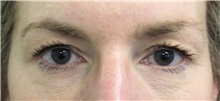 Eyelid Surgery Before Photo by Munique Maia, MD; Tysons Corner, VA - Case 51309