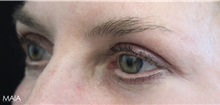 Eyelid Surgery After Photo by Munique Maia, MD; Tysons Corner, VA - Case 51312
