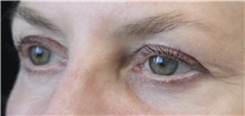 Eyelid Surgery Before Photo by Munique Maia, MD; Tysons Corner, VA - Case 51312
