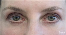 Eyelid Surgery After Photo by Munique Maia, MD; Tysons Corner, VA - Case 51312