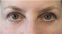 Eyelid Surgery Before Photo by Munique Maia, MD; Tysons Corner, VA - Case 51312