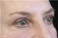Eyelid Surgery After Photo by Munique Maia, MD; Tysons Corner, VA - Case 51312