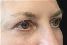 Eyelid Surgery Before Photo by Munique Maia, MD; Tysons Corner, VA - Case 51312