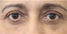 Eyelid Surgery After Photo by Munique Maia, MD; Tysons Corner, VA - Case 51313