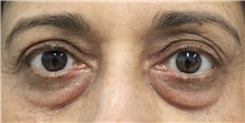 Eyelid Surgery Before Photo by Munique Maia, MD; Tysons Corner, VA - Case 51313
