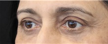 Eyelid Surgery After Photo by Munique Maia, MD; Tysons Corner, VA - Case 51313