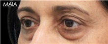Eyelid Surgery Before Photo by Munique Maia, MD; Tysons Corner, VA - Case 51313