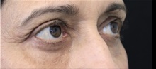Eyelid Surgery After Photo by Munique Maia, MD; Tysons Corner, VA - Case 51313