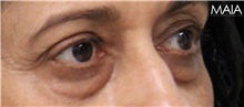 Eyelid Surgery Before Photo by Munique Maia, MD; Tysons Corner, VA - Case 51313