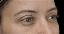 Eyelid Surgery After Photo by Munique Maia, MD; Tysons Corner, VA - Case 51314