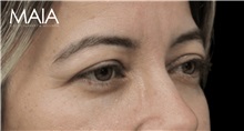 Eyelid Surgery Before Photo by Munique Maia, MD; Tysons Corner, VA - Case 51314