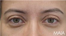 Eyelid Surgery After Photo by Munique Maia, MD; Tysons Corner, VA - Case 51314