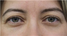Eyelid Surgery Before Photo by Munique Maia, MD; Tysons Corner, VA - Case 51314