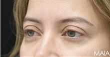 Eyelid Surgery After Photo by Munique Maia, MD; Tysons Corner, VA - Case 51314