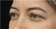 Eyelid Surgery Before Photo by Munique Maia, MD; Tysons Corner, VA - Case 51314