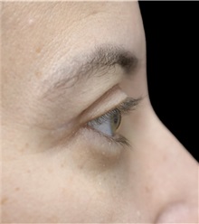 Eyelid Surgery After Photo by Munique Maia, MD; Tysons Corner, VA - Case 51314