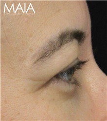 Eyelid Surgery Before Photo by Munique Maia, MD; Tysons Corner, VA - Case 51314