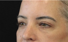Eyelid Surgery After Photo by Munique Maia, MD; Tysons Corner, VA - Case 51316