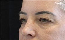 Eyelid Surgery Before Photo by Munique Maia, MD; Tysons Corner, VA - Case 51316