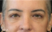 Eyelid Surgery After Photo by Munique Maia, MD; Tysons Corner, VA - Case 51316