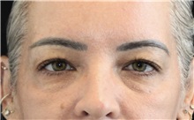 Eyelid Surgery Before Photo by Munique Maia, MD; Tysons Corner, VA - Case 51316