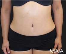 Tummy Tuck After Photo by Munique Maia, MD; Tysons Corner, VA - Case 49382