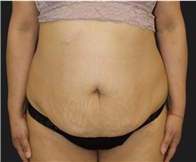 Tummy Tuck Before Photo by Munique Maia, MD; Tysons Corner, VA - Case 49382