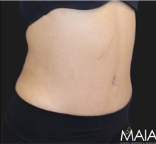 Tummy Tuck After Photo by Munique Maia, MD; Tysons Corner, VA - Case 49382