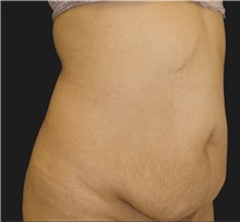 Tummy Tuck Before Photo by Munique Maia, MD; Tysons Corner, VA - Case 49382