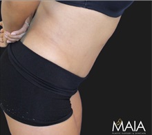 Tummy Tuck After Photo by Munique Maia, MD; Tysons Corner, VA - Case 49382