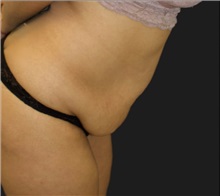 Tummy Tuck Before Photo by Munique Maia, MD; Tysons Corner, VA - Case 49382