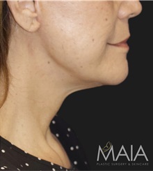 Facelift After Photo by Munique Maia, MD; Tysons Corner, VA - Case 49385