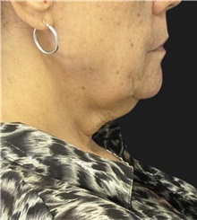 Facelift Before Photo by Munique Maia, MD; Tysons Corner, VA - Case 49385