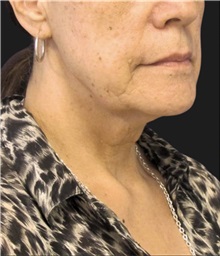 Facelift Before Photo by Munique Maia, MD; Tysons Corner, VA - Case 49385