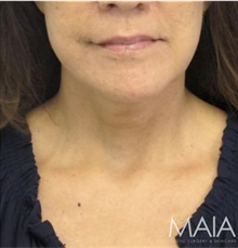 Facelift After Photo by Munique Maia, MD; Tysons Corner, VA - Case 49385