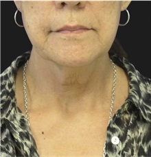 Facelift Before Photo by Munique Maia, MD; Tysons Corner, VA - Case 49385