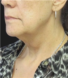 Facelift Before Photo by Munique Maia, MD; Tysons Corner, VA - Case 49385