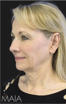 Neck Lift Before Photo by Munique Maia, MD; Tysons Corner, VA - Case 49389