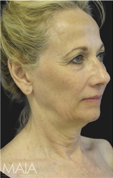 Neck Lift Before Photo by Munique Maia, MD; Tysons Corner, VA - Case 49389