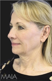 Neck Lift Before Photo by Munique Maia, MD; Tysons Corner, VA - Case 49389