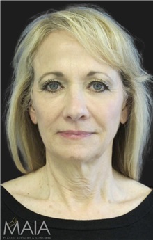 Neck Lift Before Photo by Munique Maia, MD; Tysons Corner, VA - Case 49389