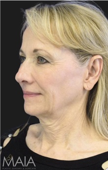 Neck Lift Before Photo by Munique Maia, MD; Tysons Corner, VA - Case 49389