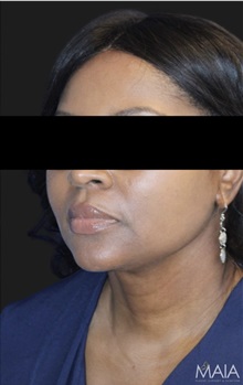 Neck Lift After Photo by Munique Maia, MD; Tysons Corner, VA - Case 49388