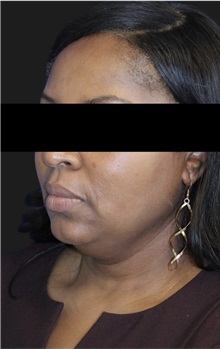 Neck Lift Before Photo by Munique Maia, MD; Tysons Corner, VA - Case 49388