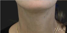 Neck Lift After Photo by Munique Maia, MD; Tysons Corner, VA - Case 49386