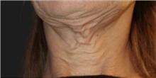 Neck Lift Before Photo by Munique Maia, MD; Tysons Corner, VA - Case 49386