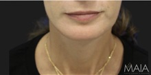 Neck Lift After Photo by Munique Maia, MD; Tysons Corner, VA - Case 49386